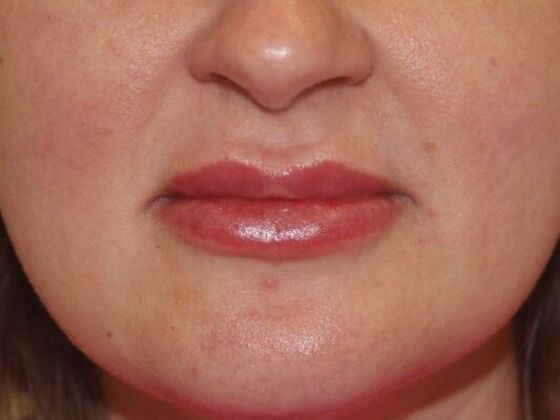 Injectables Case 64 - After