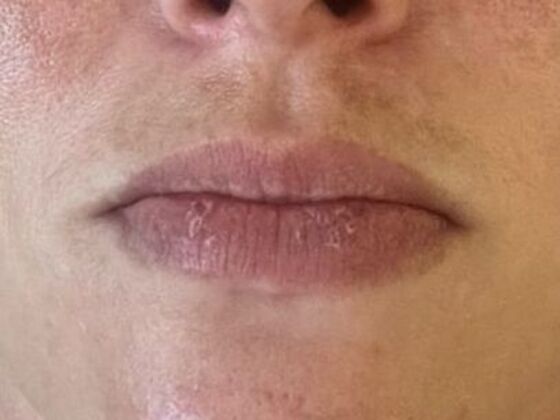 Injectables Case 65 - Before