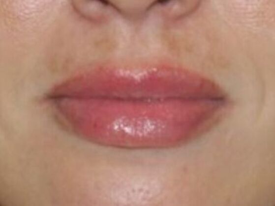 Injectables Case 65 - After