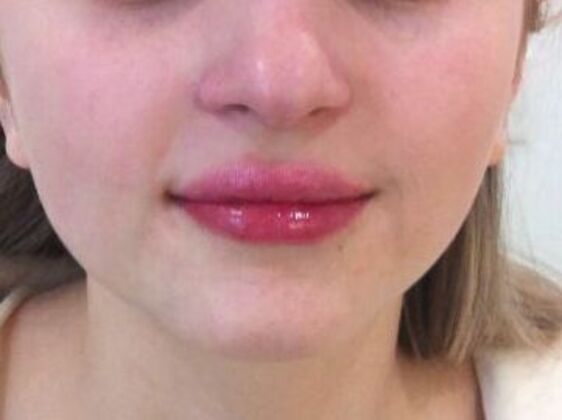 Injectables Case 66 - Before