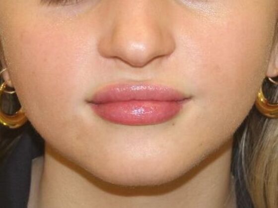 Injectables Case 66 - After