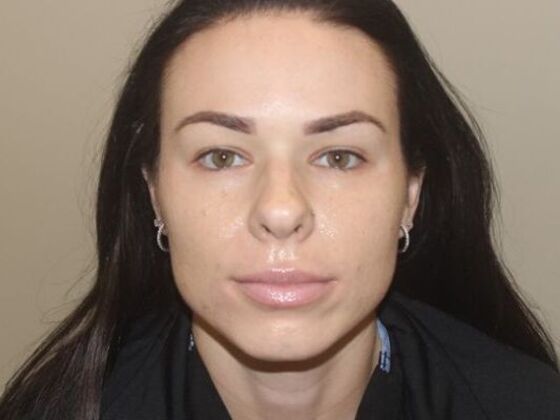 Injectables Case 67 - Before