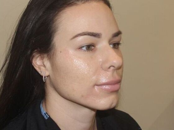 Injectables: Case 67 - Before