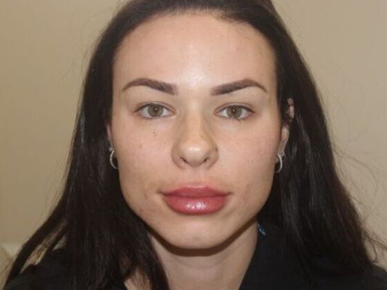 Injectables Case 67 - After