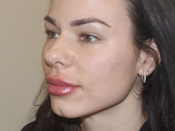 Injectables: Case 67 - After