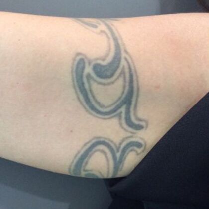 Laser Tattoo Removal Case 36 - Before