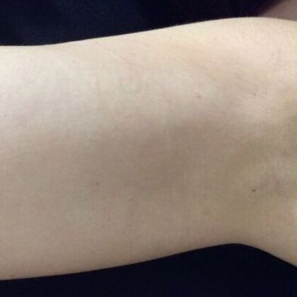 Laser Tattoo Removal Case 36 - After