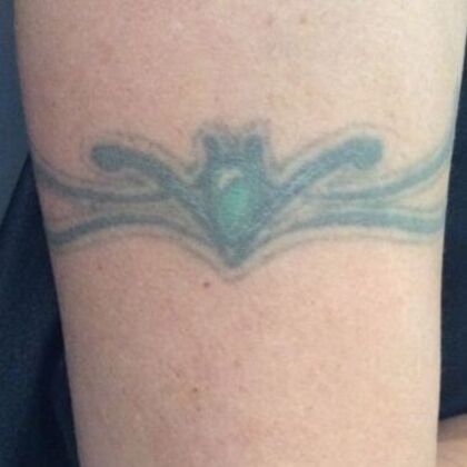 Laser Tattoo Removal: Case 36 - Before