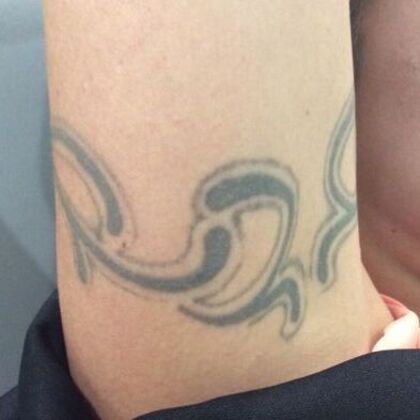 Laser Tattoo Removal: Case 36 - Before