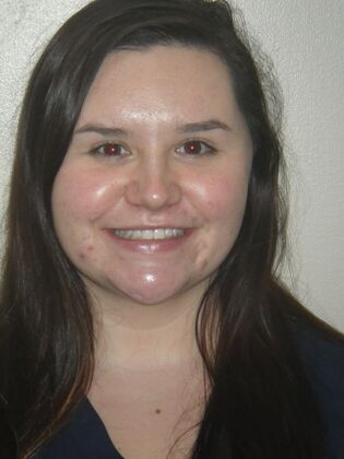 Invisalign: Case 17 - Before