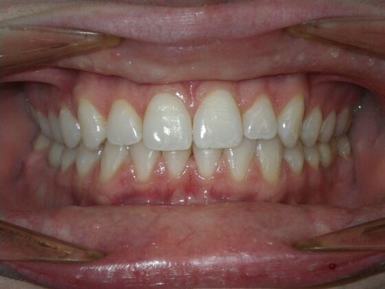 Invisalign: Case 17 - Before