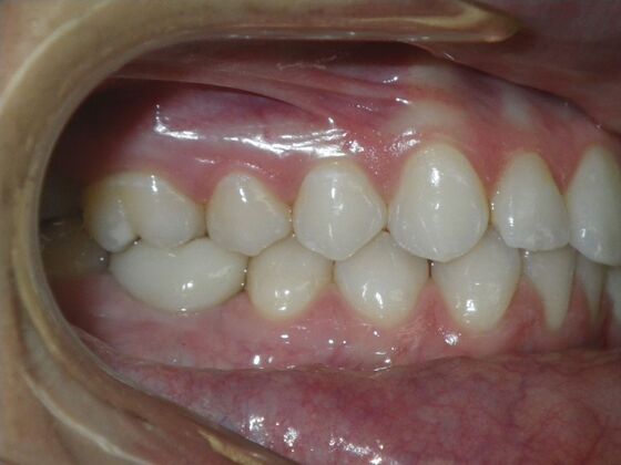 Invisalign: Case 17 - Before