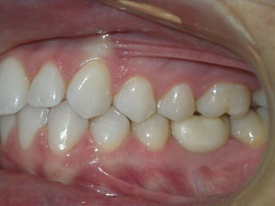 Invisalign: Case 17 - Before