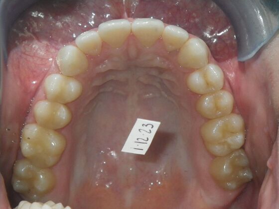 Invisalign: Case 17 - Before