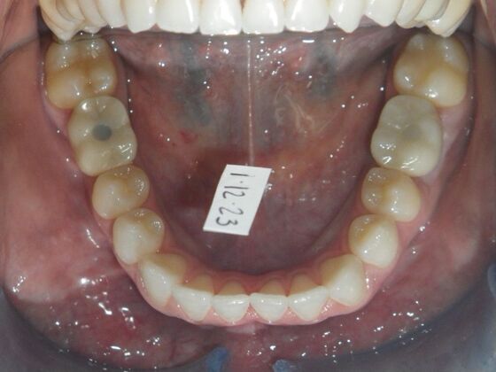 Invisalign: Case 17 - Before