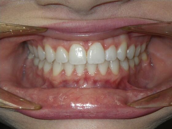 Invisalign: Case 17 - After