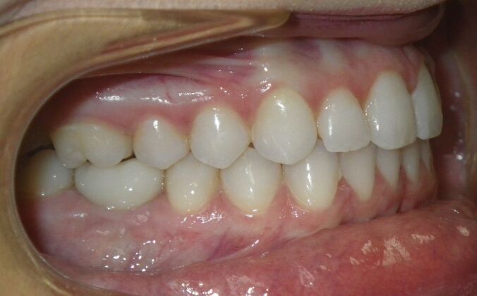 Invisalign: Case 17 - After