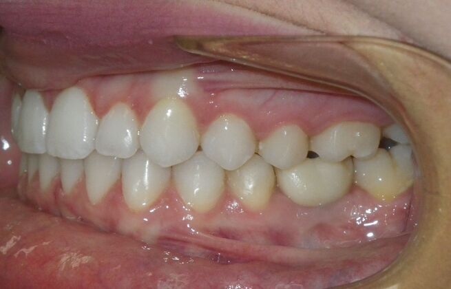 Invisalign: Case 17 - After