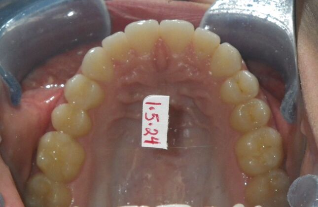 Invisalign: Case 17 - After
