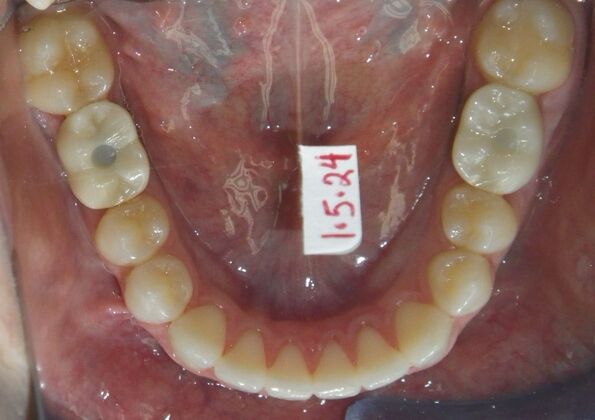 Invisalign: Case 17 - After