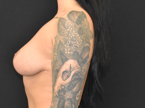 Mastopexy: Case 1 - After