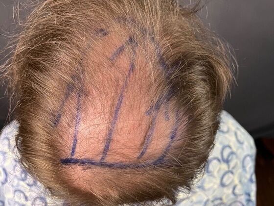 FUE Hair Restoration: Case 27 - Before