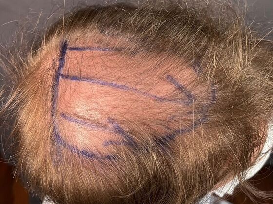 FUE Hair Restoration: Case 27 - Before