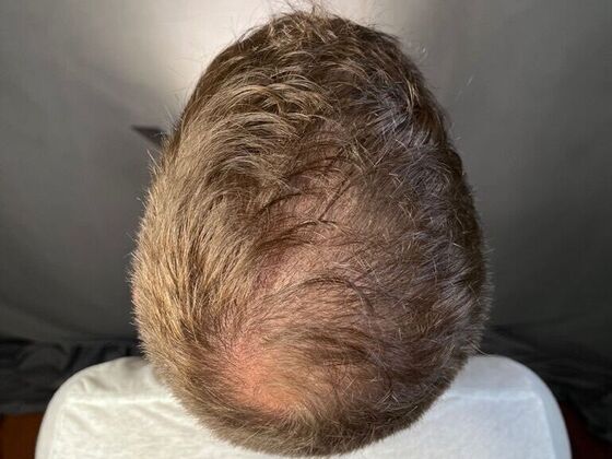 FUE Hair Restoration: Case 27 - After