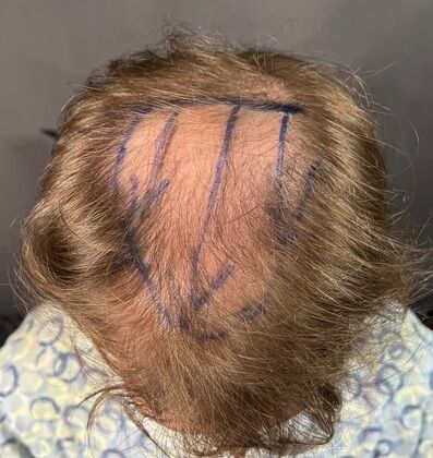 FUE Hair Restoration: Case 27 - Before