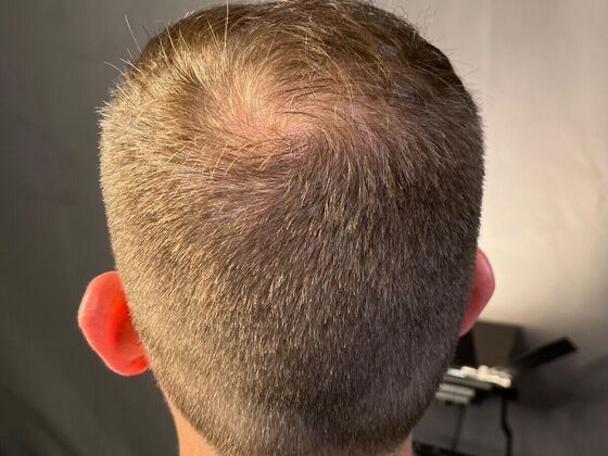 FUE Hair Restoration: Case 27 - After