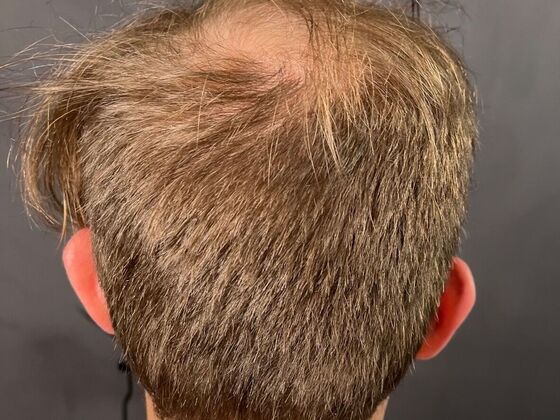 FUE Hair Restoration: Case 27 - Before