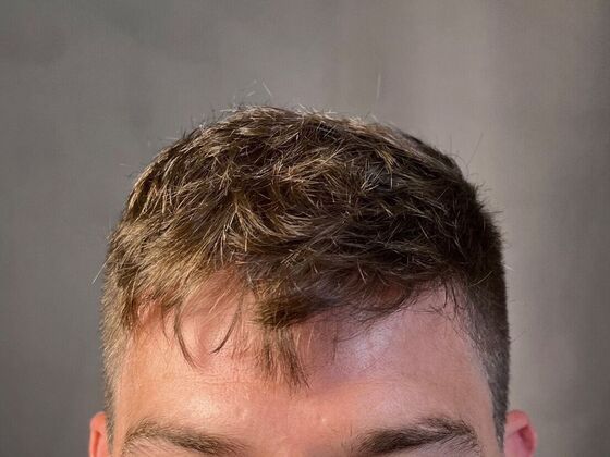 FUE Hair Restoration: Case 27 - After