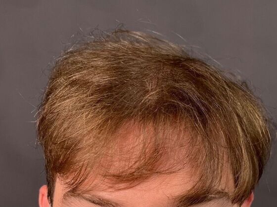 FUE Hair Restoration: Case 27 - Before