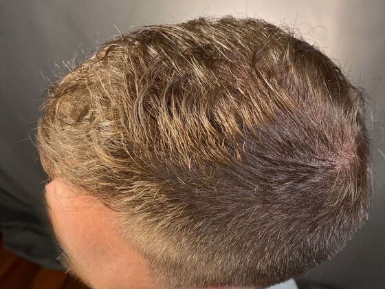 FUE Hair Restoration: Case 27 - After