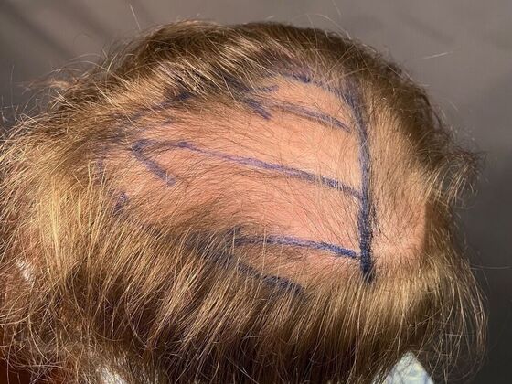 FUE Hair Restoration: Case 27 - Before