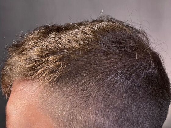 FUE Hair Restoration: Case 27 - After