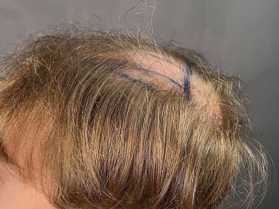 FUE Hair Restoration: Case 27 - Before