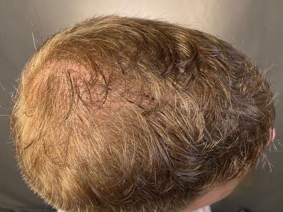 FUE Hair Restoration: Case 27 - After