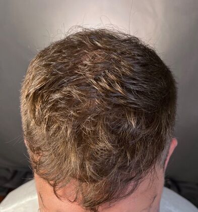 FUE Hair Restoration: Case 27 - After