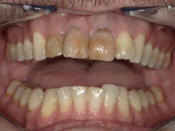 Smile Design Case 5 - Before