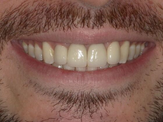 Smile Design Case 5 - After