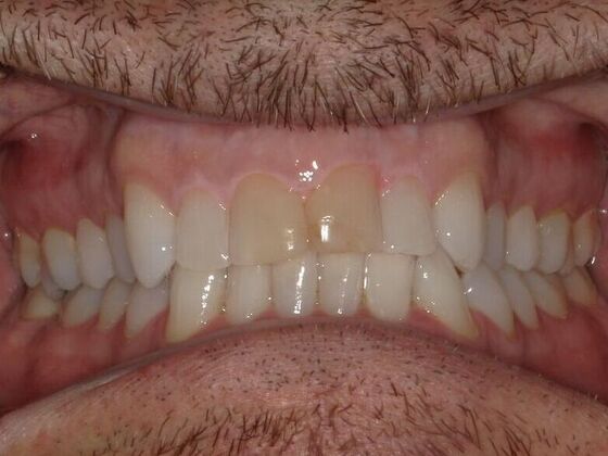 Dental Crowns Case 4 - Before