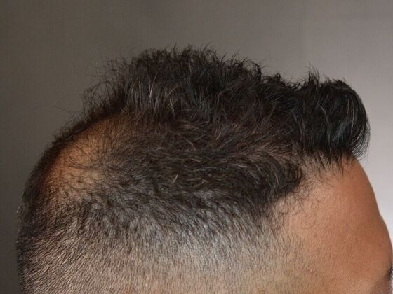 FUE Hair Restoration: Case 28 - Before