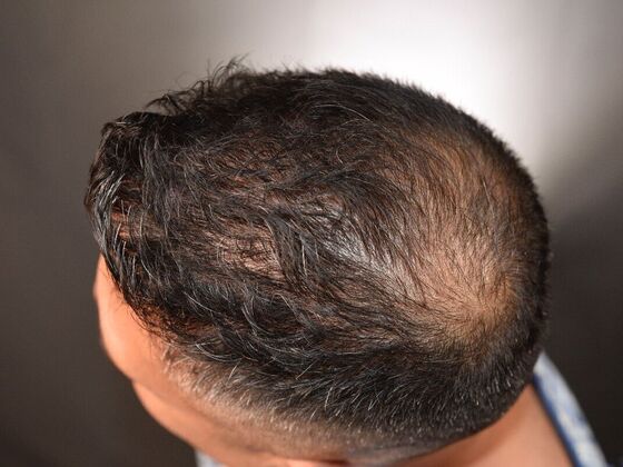 FUE Hair Restoration: Case 28 - Before