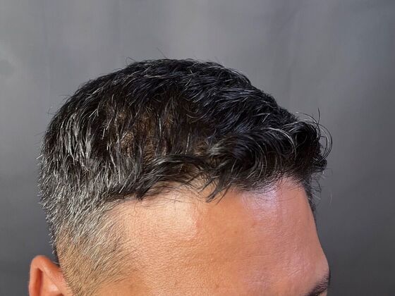 FUE Hair Restoration: Case 28 - After