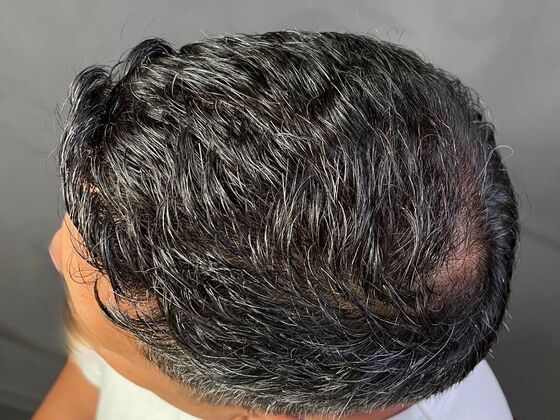 FUE Hair Restoration: Case 28 - Before