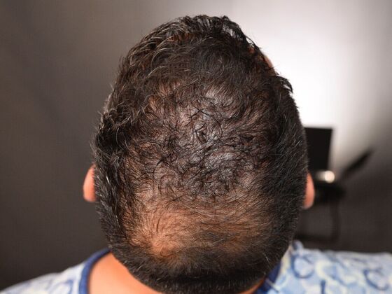 FUE Hair Restoration: Case 28 - Before
