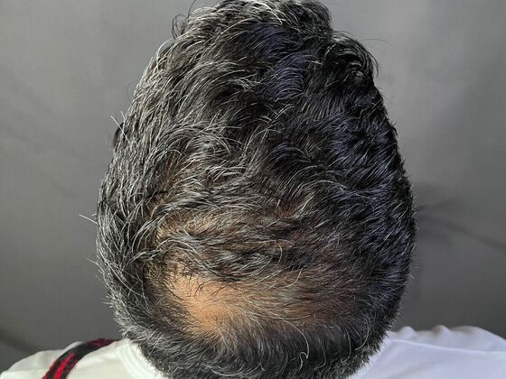 FUE Hair Restoration: Case 28 - After