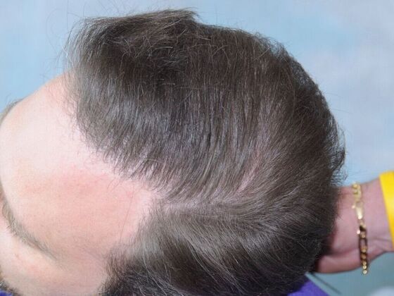 FUT Hair Restoration: Case 33 - After
