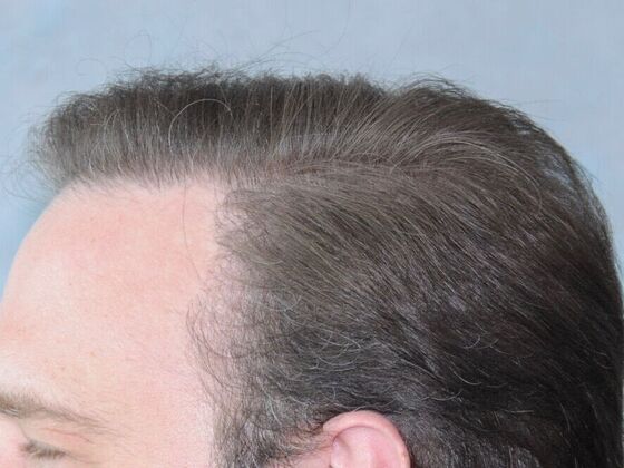 FUT Hair Restoration: Case 33 - After